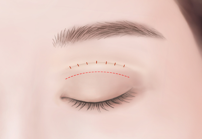 Adhesion Release & Correction